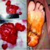 Unusual Presentation of Mycetoma of the Foot: A Rare Case Report