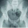 Anti-inflammatory Prophylaxis Prevents Heterotopic Ossification in Contralateral Side Hip Arthroscopy: A Case Report
