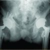 Bilateral prosthetic hip joint infections associated with a Psoas abscess. A Case Report