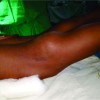 Pigmented Villonodular Synovitis Presenting as a Popliteal Cyst