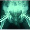 An unusual case of simultaneous bilateral neck of femur fracture following electrocution injury-A case report and review of literature