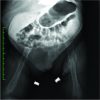 Bilateral Femoral Fracture in a newborn with Myelomeningocele at Cesarean section: A Case Report