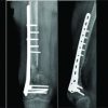 Management of Large Bone Defects in Diaphyseal Fractures by Induced Membrane Formation by Masquelet’s Technique