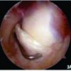 Post-traumatic Medial Meniscal Cyst in young: A case report