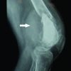 Recurrent GCT of Distal Femur Treated with Resection Arthrodesis with Non-Vascularized Bilateral Fibular Graft and A Custom -Made Interlock Nail