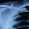 Delayed Presentation of Osteochondroma at Superior Angle of Scapula- A Case Report