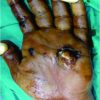 Simultaneous open and Closed Dislocation of four Metacarpophalangeal Joints: A Case Report and Review of Literature
