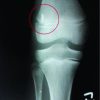 An unusual case of partial Anterior Cruciate ligament (ACL) tear secondary to a glass foreign body in an adolescent knee joint