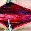 Isolated Acute Exertional Compartment Syndrome (AECS) of the Extensor Carpi Ulnaris