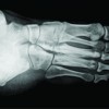 Melorheostosis of the Foot: A Case Report of A rare entity with a Review of Multimodality Imaging Emphasizing the Importance of Conventional Radiography in Diagnosis