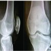 Case Report of Two Cases of Patella Subacute Osteomyelitis in Diabetic Women A Rare Entity