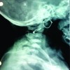 Spinal Cord Injury without Radiological Abnormality in an 8 Months Old Female Child: A Case Report