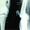 An Unusual Case of Acl Cyst with Multiple Melon Seed Bodies of the Knee