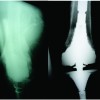Mechanical Failure of Revision Knee Prosthesis at Both Femoral and Tibial Modular Metaphyseal Stem Junctions