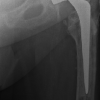 Ipsilateral Intracapsular Hip Fracture 2 Years after Fixation of Extracapsular Fracture by Dynamic Hip Screw
