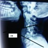 Are Two Surgeries Necessary for Correction of 1 Deformity- Cervical Kyphosis in Neurofibromatosis?- A Rare Case Report