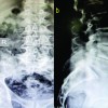 Degenerative Sacrolisthesis of S1-S2: A Case Report