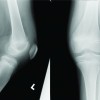 Acute Knee Pain in a Child Due to Pigmented Villonodular Synovitis