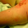 Decompression of Neglected Compartment Syndrome of the Arm