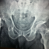 Total Hip Arthroplasty in a Girdlestone Hip following a Failed Hemiarthroplasty