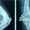 Atypical Presentation of Tuberculosis of Elbow Joint in Operated Case of Distal Humerus Fracture