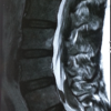 Spinal Subdural Haematoma