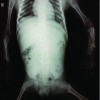 Rare Case of Rhizomelic Chondrodysplasia Punctata