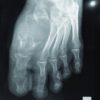 An Unusual Case of Giant Cell Tumor of First Metatarsal: A Rare Case Report and Review of Literature
