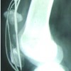 Modified Ilizarov in difficult  Fracture of the Patella.  A case report