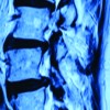 Isolated Proximal Fibular Stress Fracture In Osteoarthritis Knee Presenting As L5 Radiculopathy