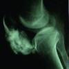 Differential diagnosis of BPOP arising in relation to patella