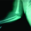 Epihyseal Separation of Lower end Humerus in A Neonate- Diagnostic and Management Difficulty