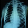 A Rare Case of Progressive Gorham’s Disease of Right Shoulder Girdle and Cervical Spine in A Child: 10 Year Follow-up and A Review of Literature