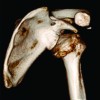 Neglected Anterior Dislocation of Shoulder: is surgery necessary? A Rare Case with review of literature.