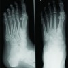 Bilateral Adrenal Adenoma Presented As Multiple Metatarsal And Phalangeal Fractures