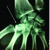 Isolated Coronal Fracture of Trapezium-  A Case Report with Review of Literature