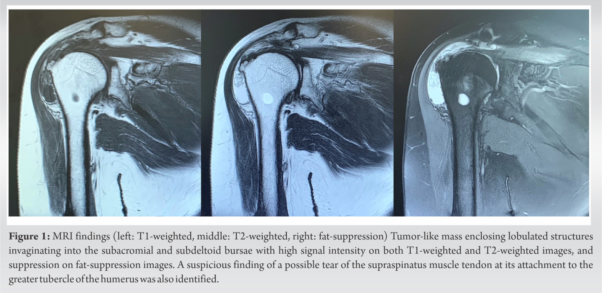 Severe Shoulder Pain Caused by Lipoma Arborescens in the Subdeltoid ...