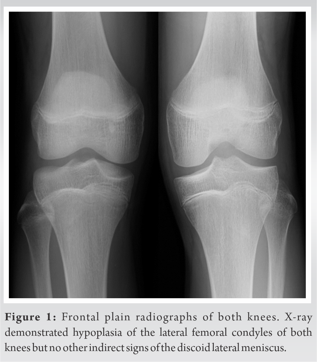 Bilateral Medial and Lateral Discoid Menisci: A Case Report | Journal ...