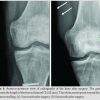 Intra-articular Partial Acetabular Resection and Allograft Reconstruction for Synovial Sarcoma