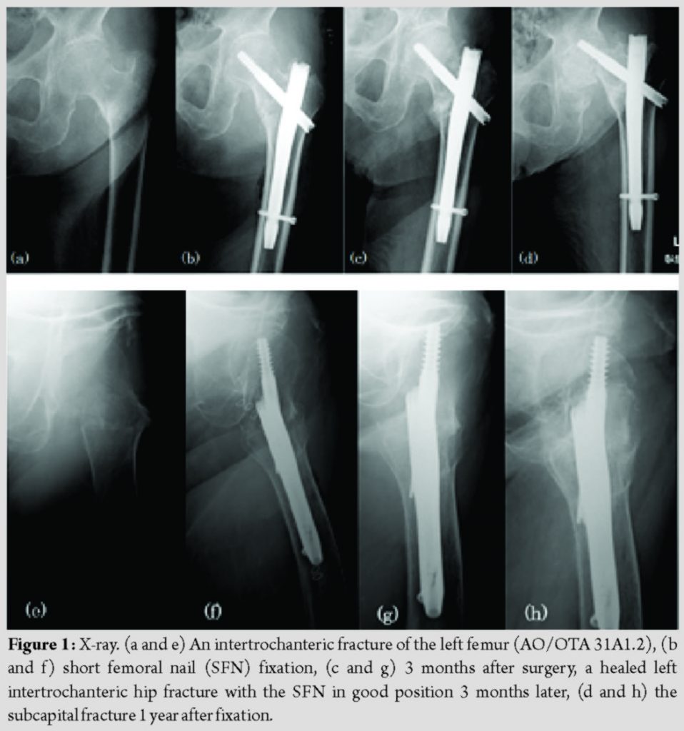 Subcapital Fracture with Avascular Necrosis of the Whole Femoral Head ...