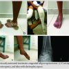 Neglected Idiopathic Clubfoot Successfully Treated by the Ponseti Method: A Case Report of an Adult Patient who Started Treatment at 26 Years of Age