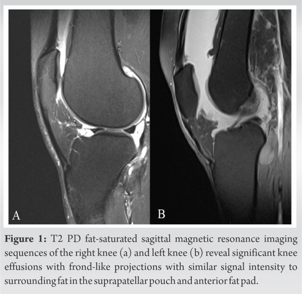 A Case Report of Bilateral Lipoma Arborescens: An Unusual Consideration ...