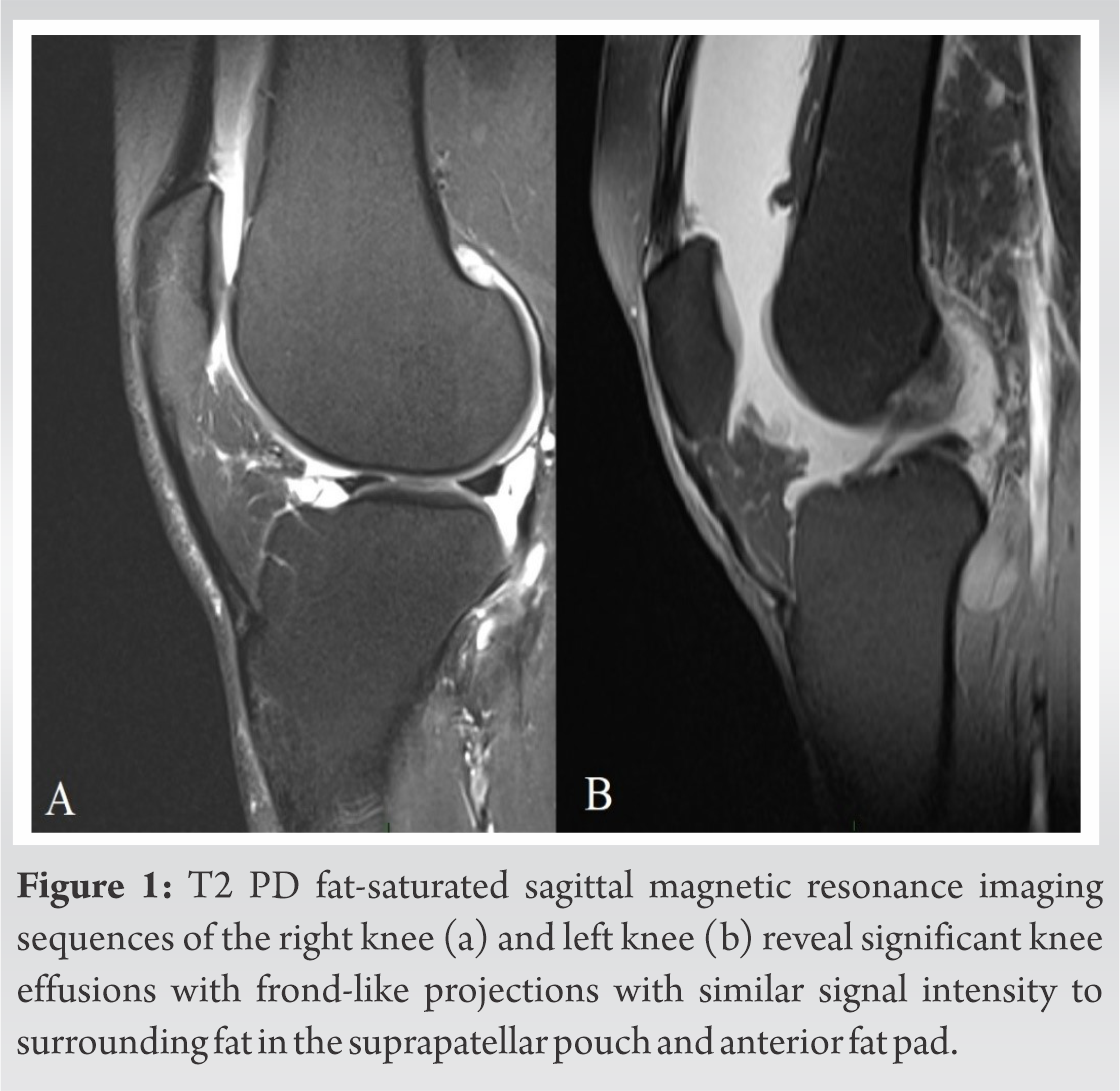 A Case Report Of Bilateral Lipoma Arborescens: An Unusual Consideration 