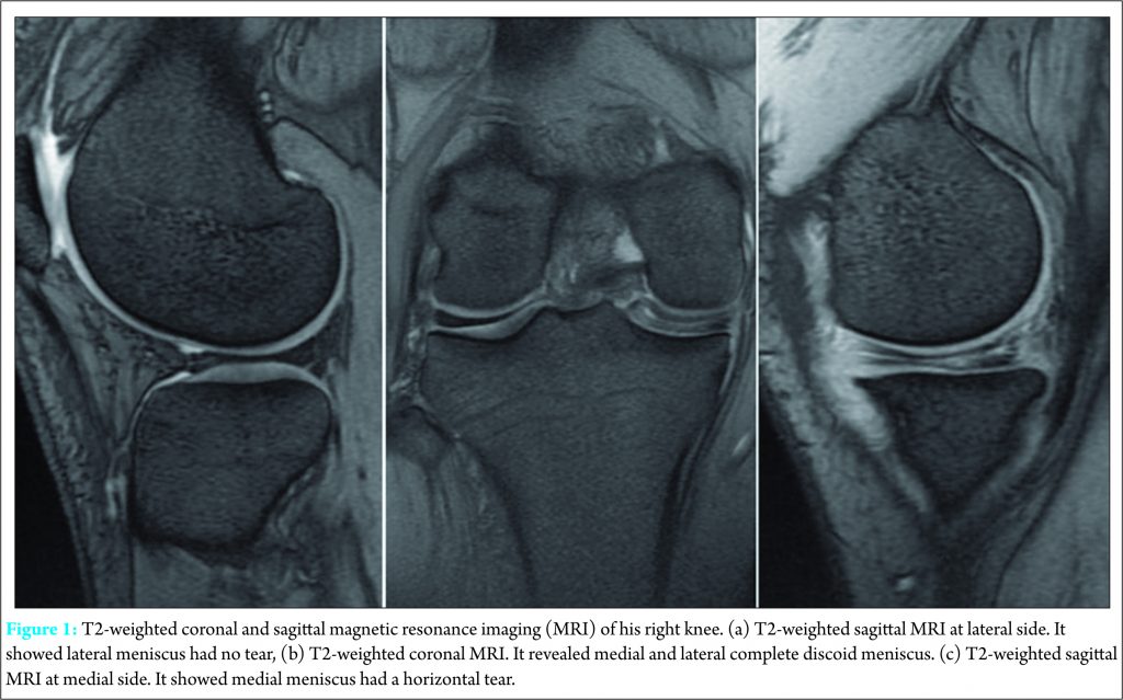 Ipsilateral Medial And Lateral Discoid Meniscus With Medial Meniscus 