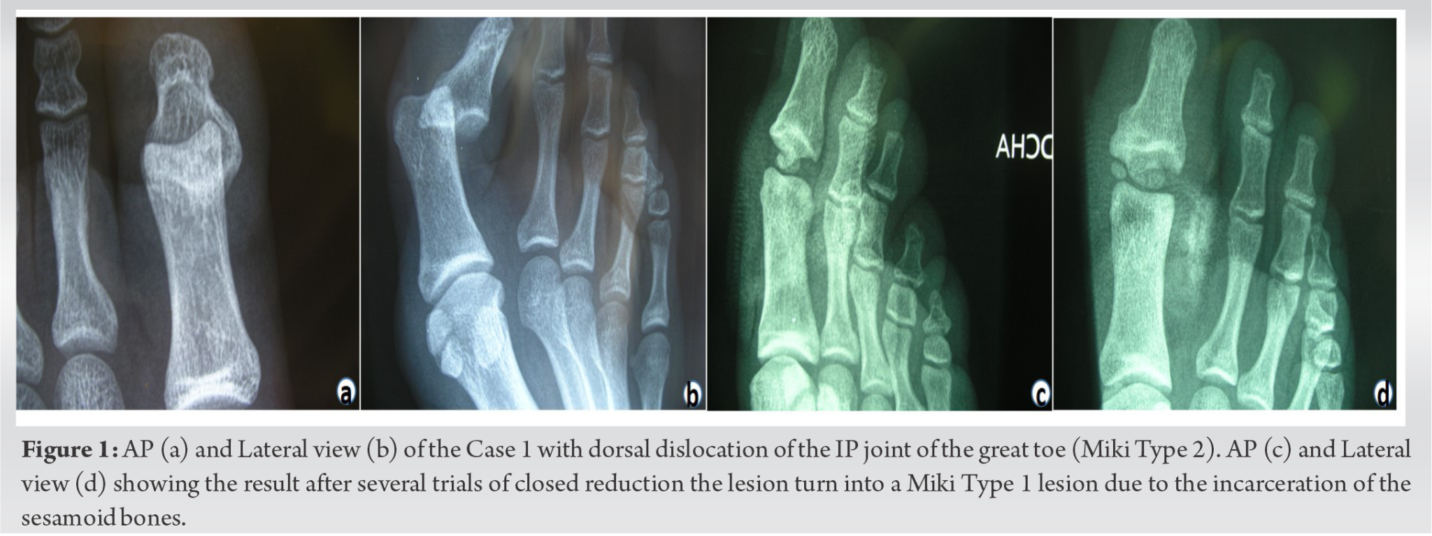 what-is-a-great-toe-fracture-how-to-manage-this-injury-upswing-health