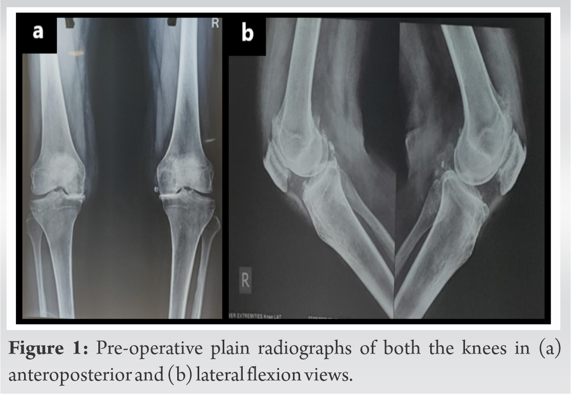 Delayed Recovery Of Idiopathic Common Peroneal Nerve Palsy After Total 