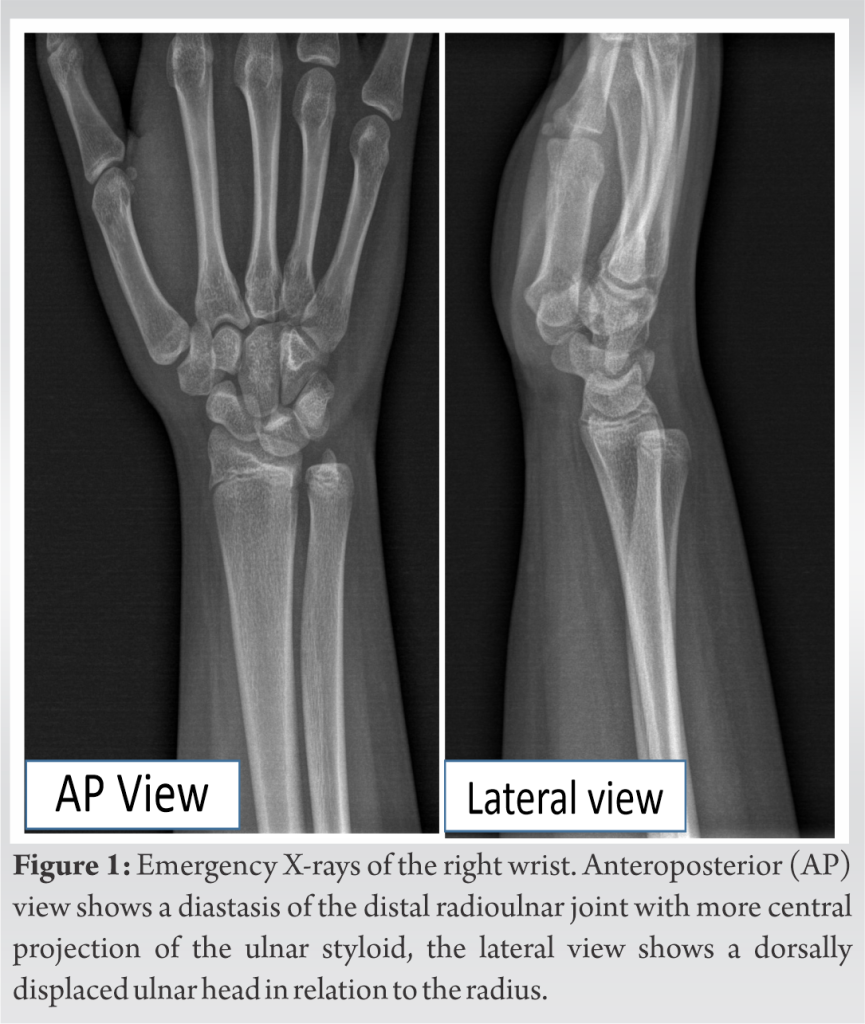 Isolated Acute Dorsal Distal Radioulnar Joint Dislocation: A Case ...