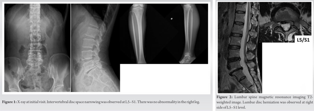Fig-1-2-20-1024×362 | Journal of Orthopaedic Case Reports