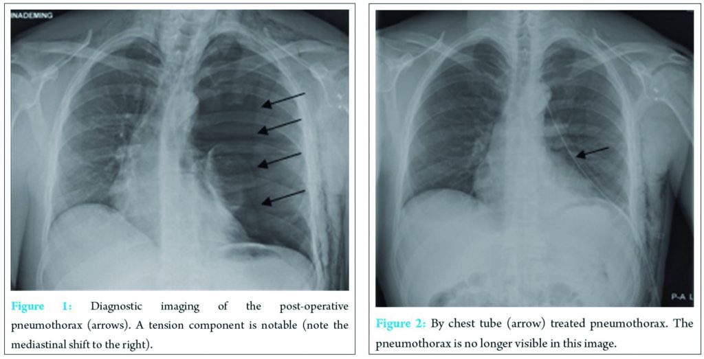 Pneumothorax After Shoulder Arthroscopy: A Rare but Life-threatening ...