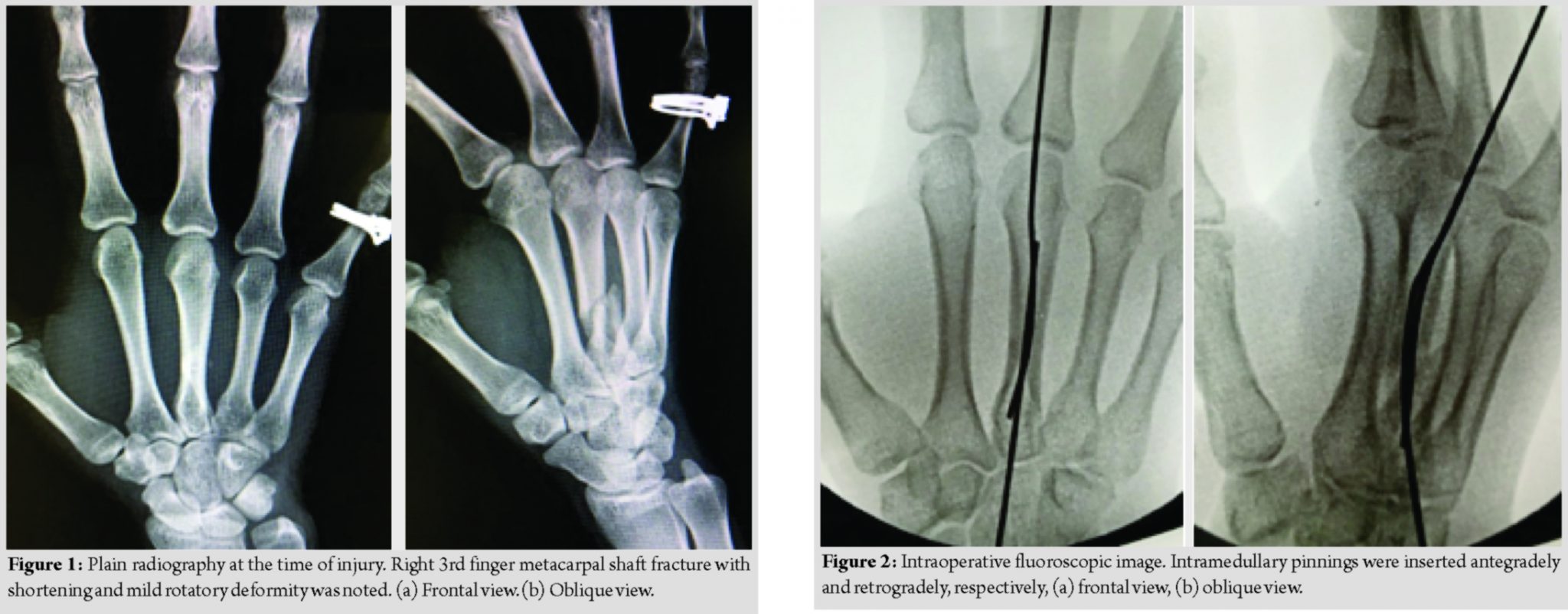 Treatment for a Metacarpal Shaft Fracture using Locked Wire Fixator: A ...